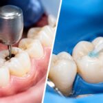 Dental Drill vs Painless Liquid Cavity Treatment